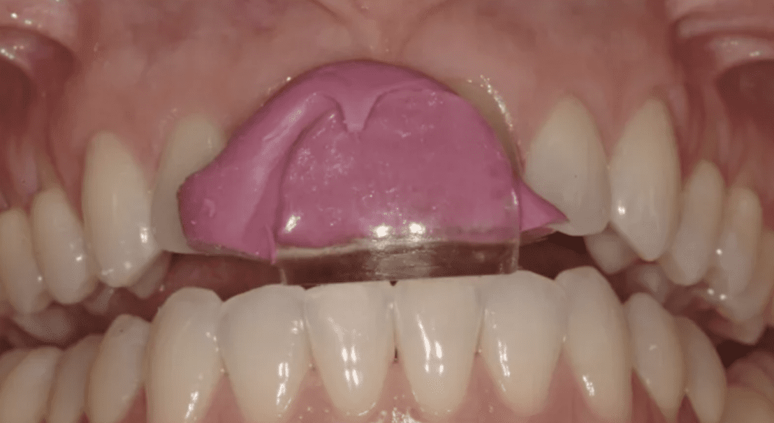 My Favorite Occlusal Deprogrammers