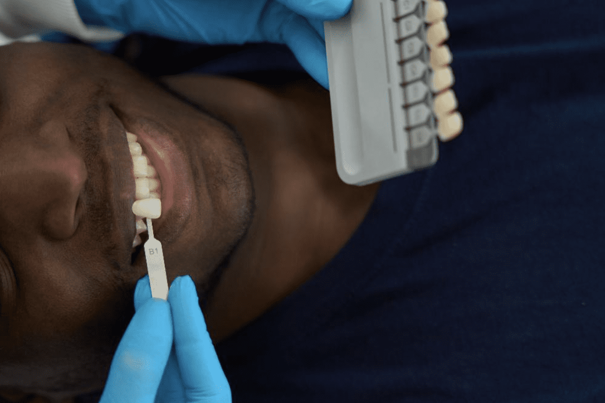 A Conservative Approach for Missing Lateral Incisors